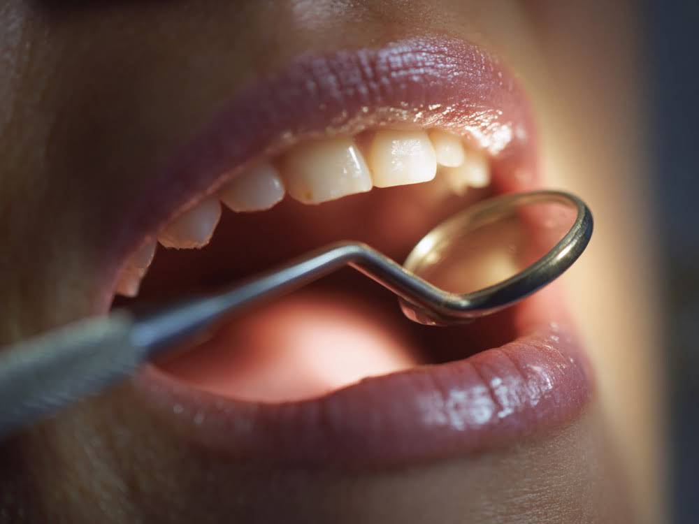 Лечение кариеса в Электростали