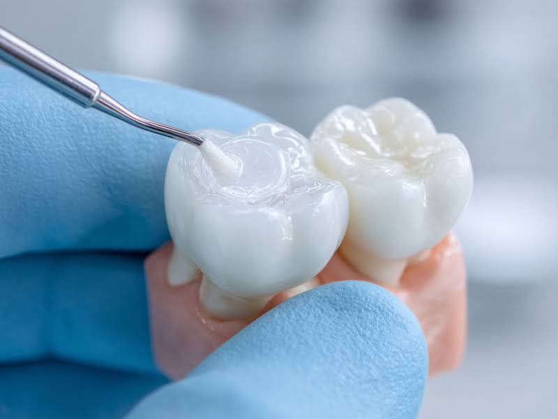 Установка коронок в Электростали